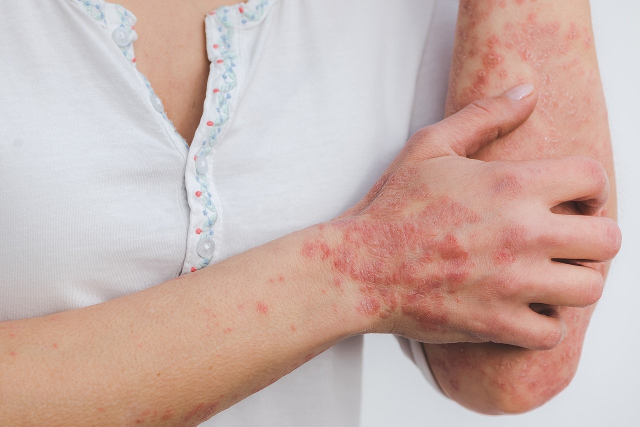 A Psoriase: Uma Jornada de Gestão da Inflamação